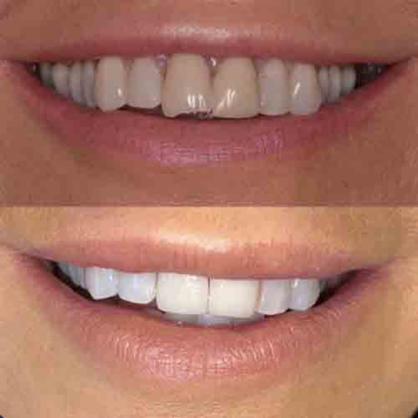 Veneers Veneers